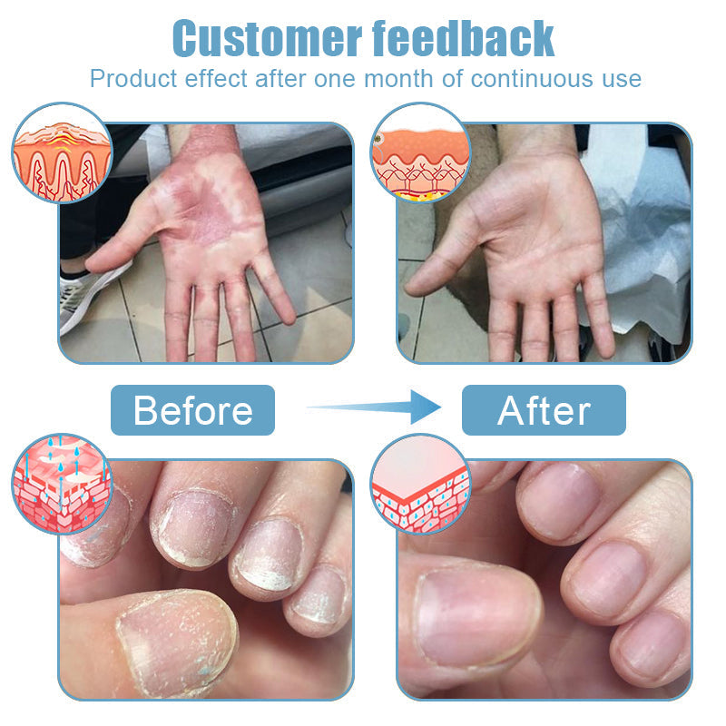đBee Poison & Ocean Natural Eczema Psoriasis Relief Cream (For all skin conditions)