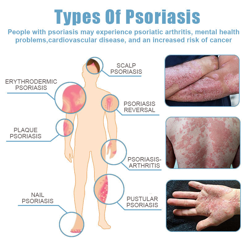 đBee Poison & Ocean Natural Eczema Psoriasis Relief Cream (For all skin conditions)