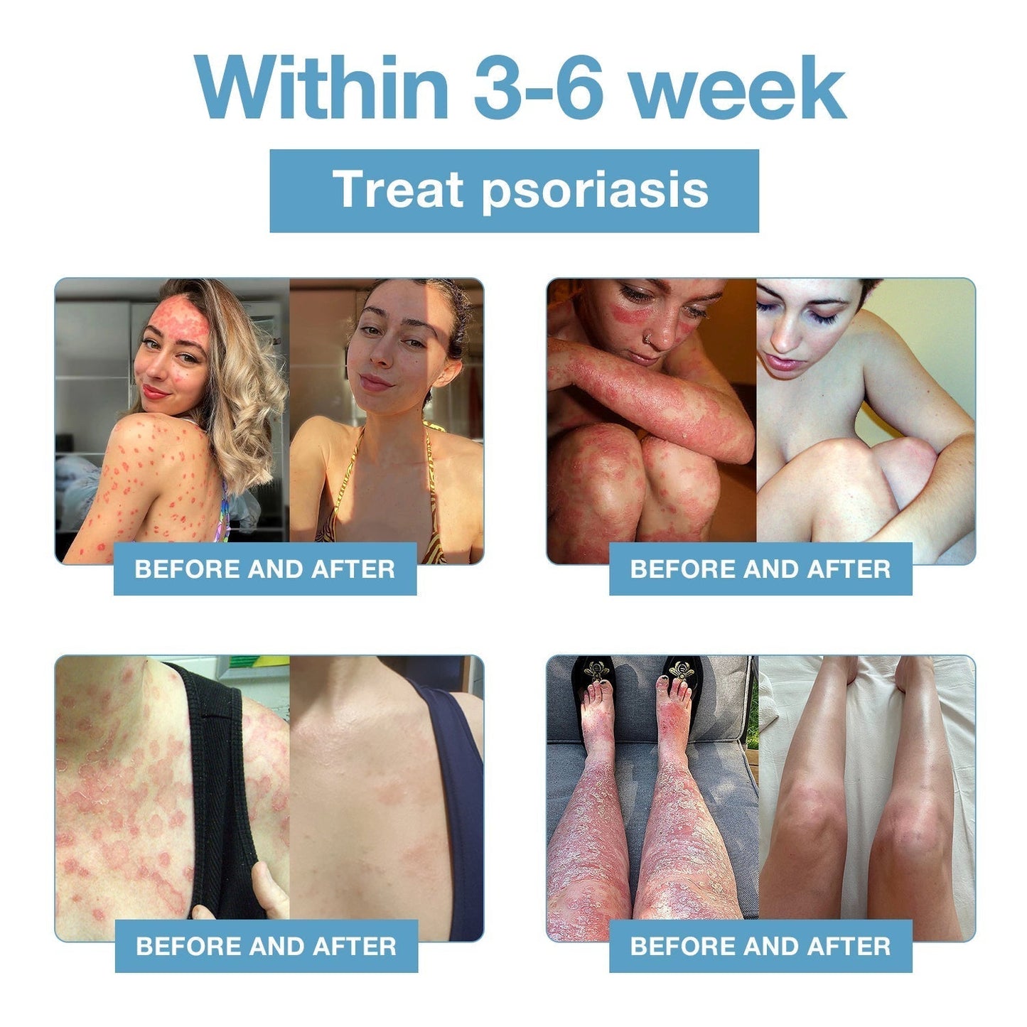 đBee Poison & Ocean Natural Eczema Psoriasis Relief Cream (For all skin conditions)