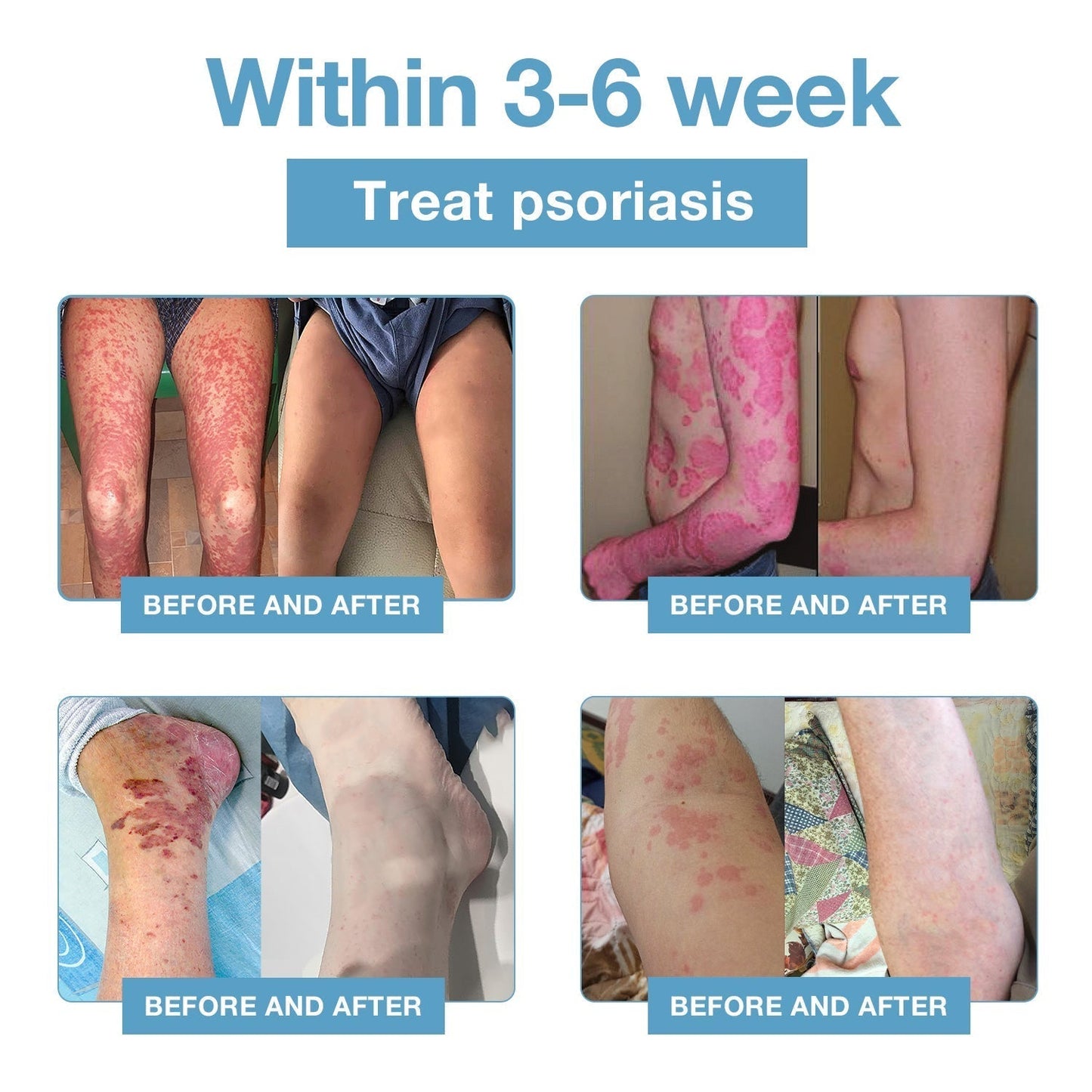 đBee Poison & Ocean Natural Eczema Psoriasis Relief Cream (For all skin conditions)