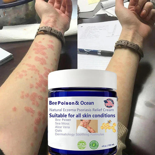 đBee Poison & Ocean Natural Eczema Psoriasis Relief Cream (For all skin conditions)