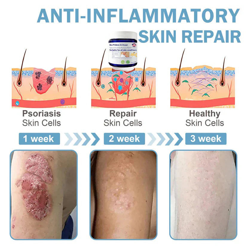 đBee Poison & Ocean Natural Eczema Psoriasis Relief Cream (For all skin conditions)