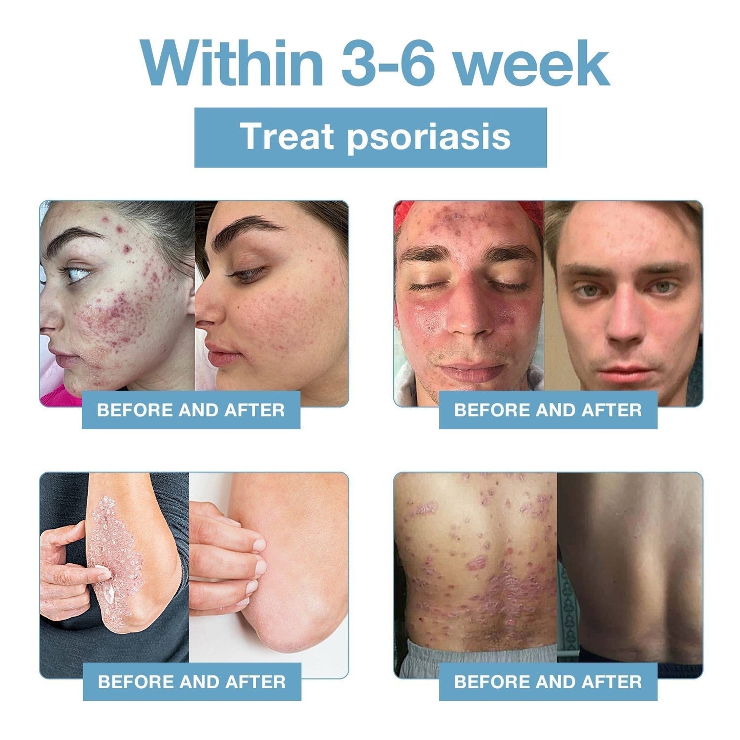 đBee Poison & Ocean Natural Eczema Psoriasis Relief Cream (For all skin conditions)